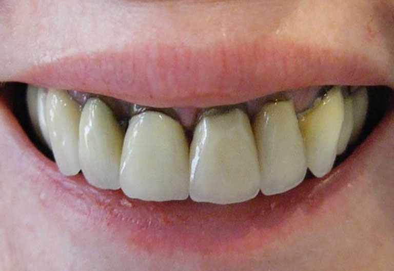 Nguyên nhân dẫn đến tình trạng răng bọc sứ bị viêm tủy 