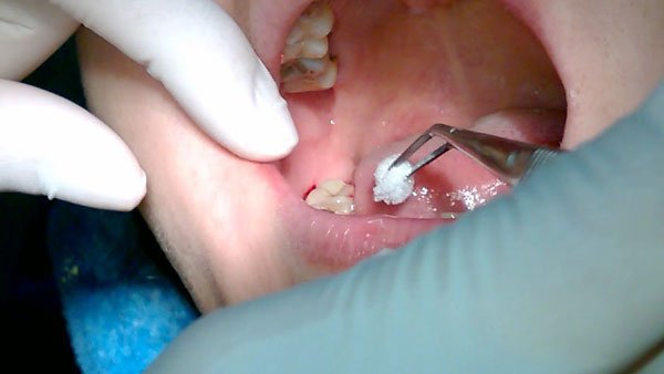 Nhổ răng số 8 hàm trên có gây nguy hiểm không? 