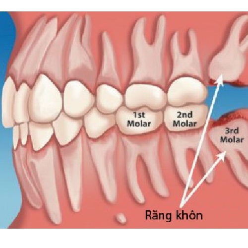 Nhổ răng số 8 hàm trên có nguy hiểm hơn hàm dưới?