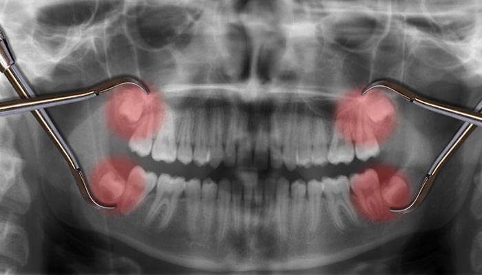 Quá trình đau sau khi nhổ răng khôn