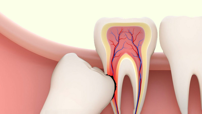 Răng khôn mọc lệch, mọc ngầm gây ra những tác hại gì?