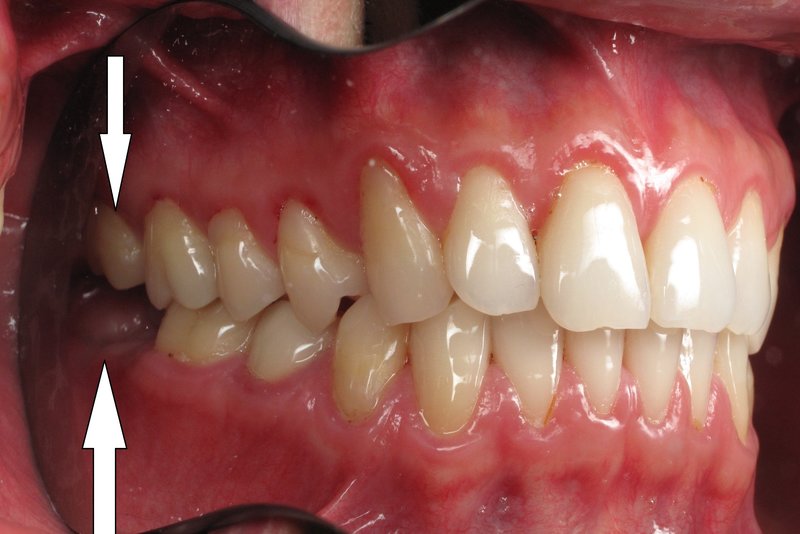 Răng khôn số 8 hàm trên là răng gì?