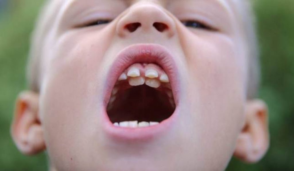 Răng mọc lệch gây ra những ảnh hưởng như thế nào?