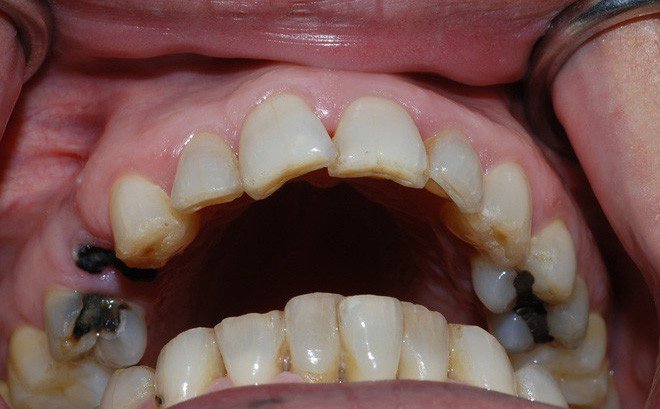 Răng mọc sai khiến sâu răng