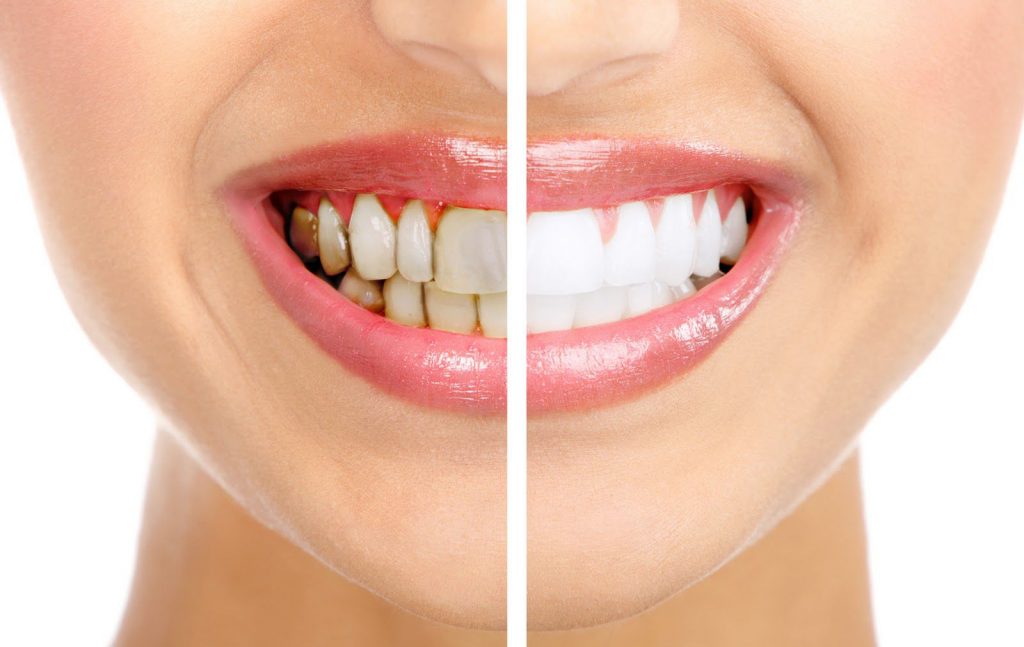 Răng sứ có tẩy trắng được không?