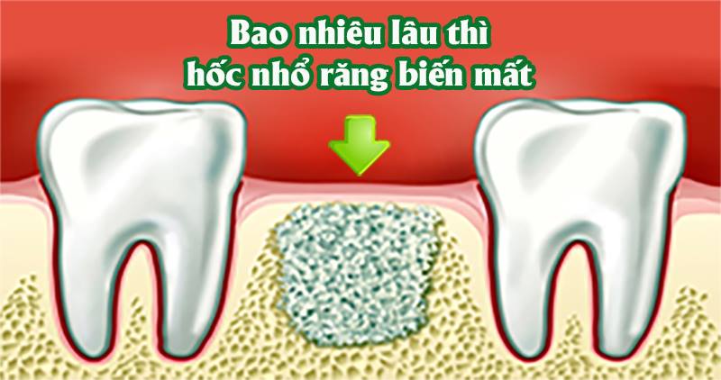 Sau khi nhổ răng khôn mất bao lâu thì lỗ mới lành?