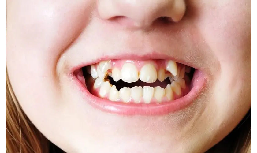 Tác hại của tình trạng bọc răng sứ bị lệch khớp cắn 