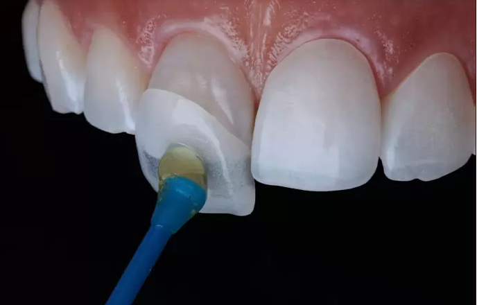 Thế nào là bọc răng sứ bị lệch khớp cắn?