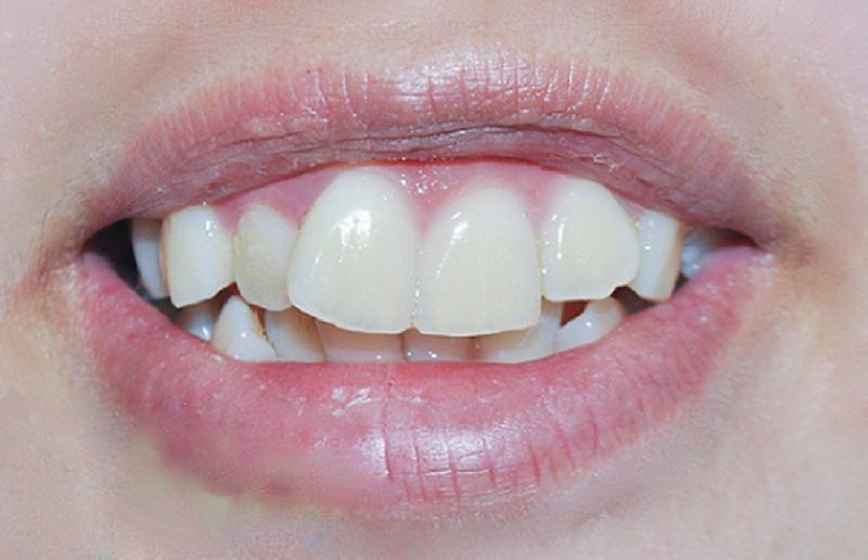 Trường hợp nào có thể bọc răng sứ cho 2 răng cửa bị hô