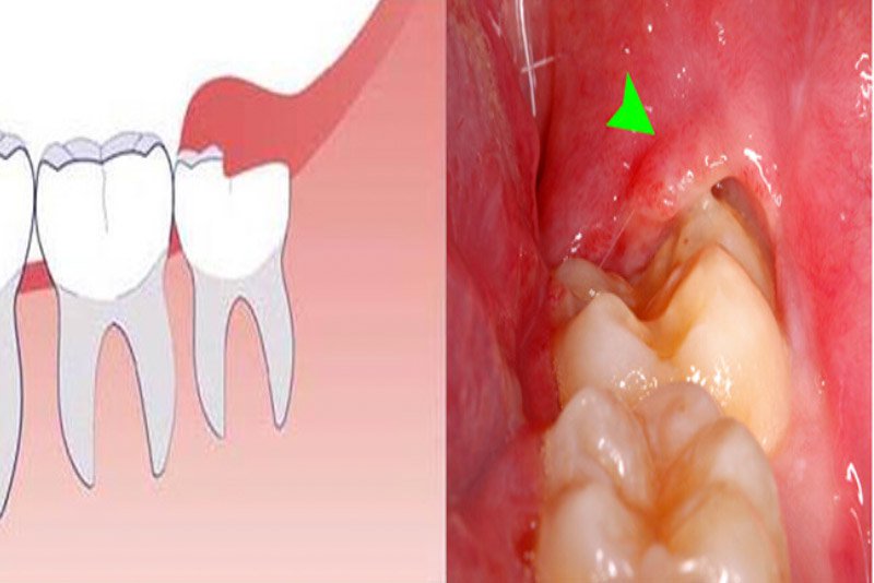 Trường hợp nào không nên nhổ răng khôn hàm dưới?