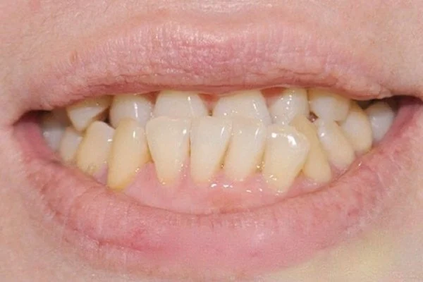 Trường hợp răng bị móm nặng