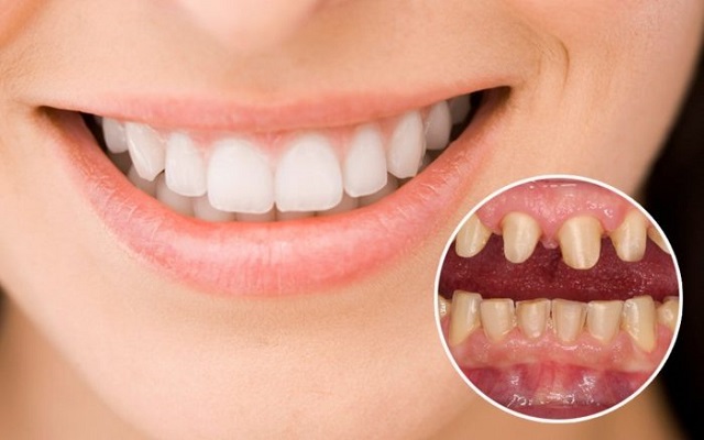 Bọc răng sứ an toàn và chất lượng phụ thuộc vào những yếu tố nào