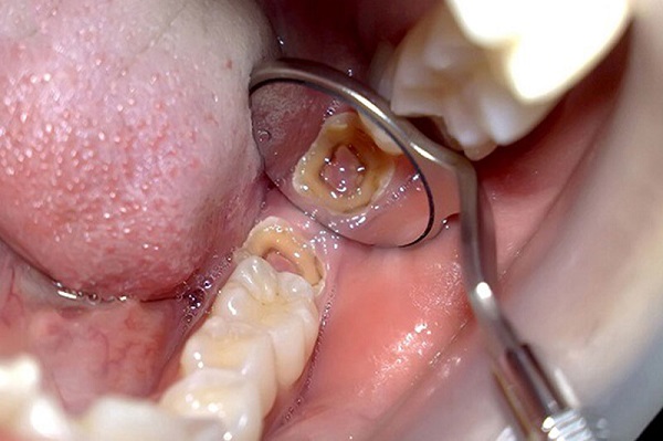 nhổ răng tại nha khoa Phương Nam