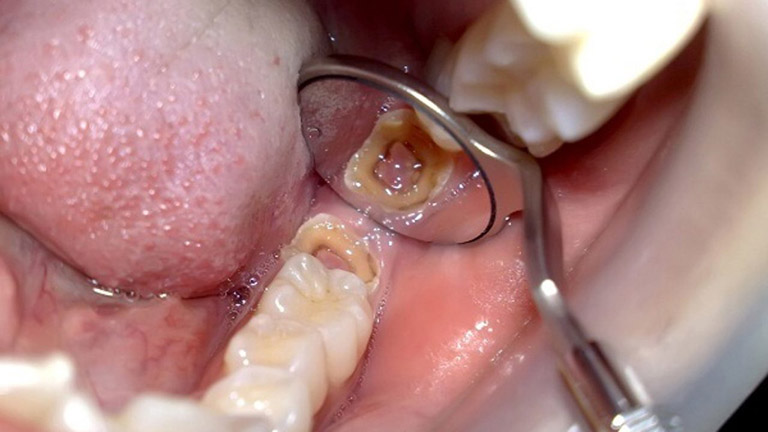 Răng khôn biến chứng nguy hiểm như thế nào