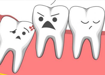 răng khôn mọc lệch nhưng không đau có nên nhổ