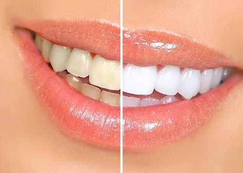 răng sứ bị đổi màu