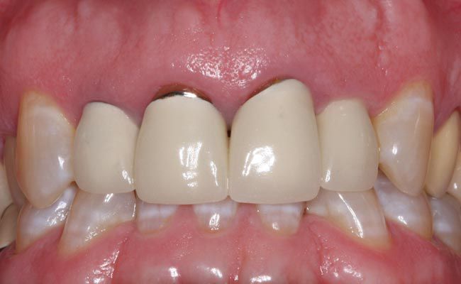 răng sứ kim loại có tốt không
