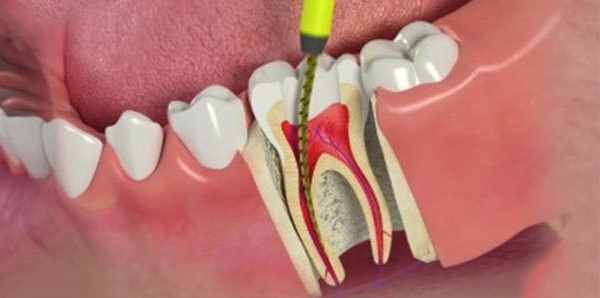 Bọc răng sứ lấy tủy khi răng bị sâu tình trạng nặng