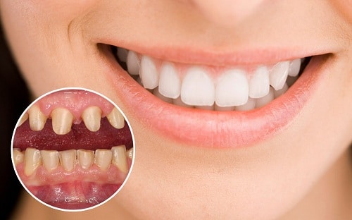 Các bệnh lý răng miệng gặp phải trước khi bọc răng sứ