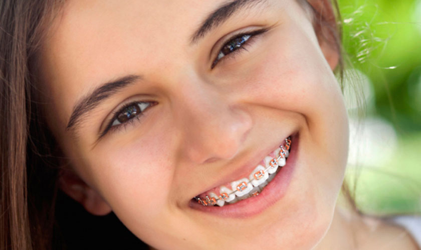 Các yếu tố tác động đến thời gian trẻ em niềng răng trong bao lâu 