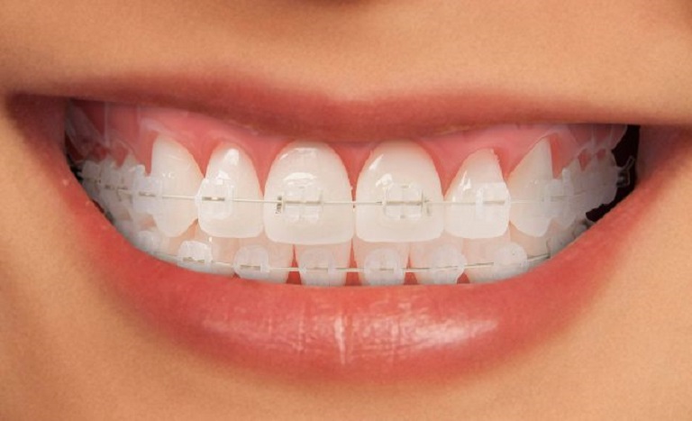 Đặc điểm phương pháp niềng răng mắc cài sứ