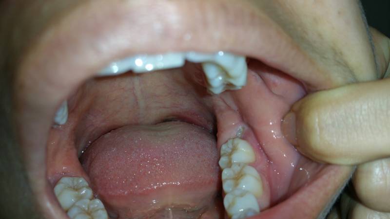 Dấu hiệu mọc răng cấm ở trẻ 