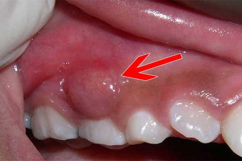 Dấu hiệu nhận biết tình trạng áp xe răng ở trẻ em
