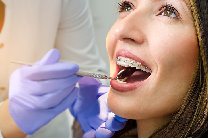Hậu quả niềng răng mắc cài - Mất canxi răng