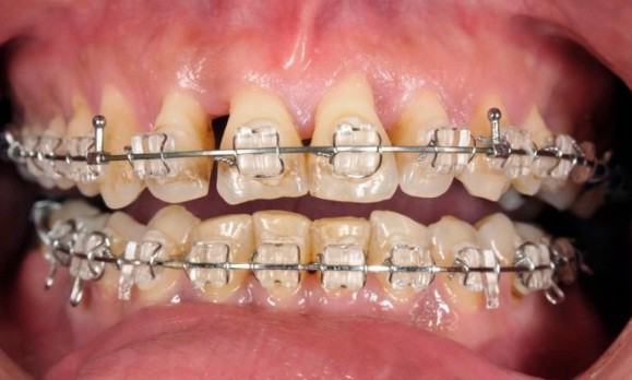 Hậu quả niềng răng mắc cài - Tiêu chân răng