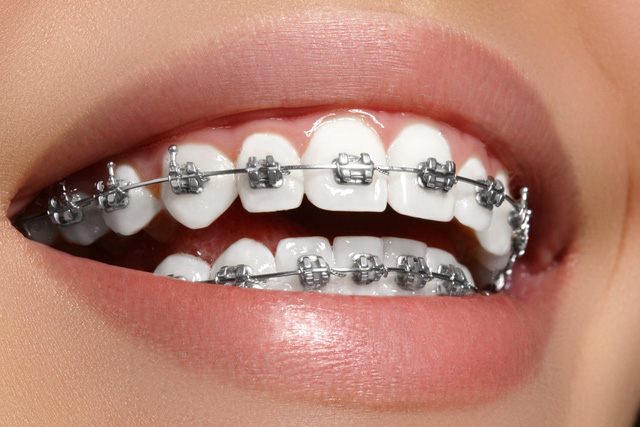 Hướng dẫn các cách lựa chọn niềng răng kim loại