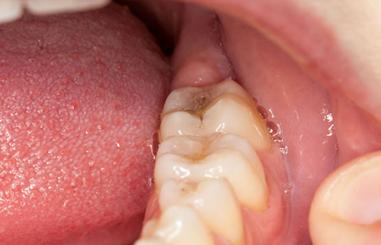Khắc phục tình trạng sưng nướu răng sau khi nhổ răng khôn