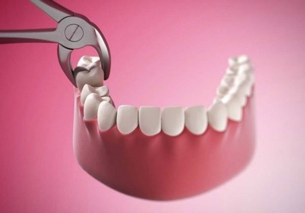 Khoảng thời gian hồi phục sau nhổ răng khôn là bao lâu? 