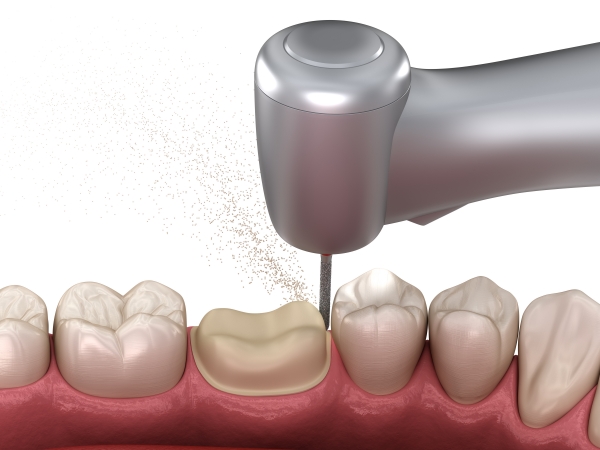 Làm sao để khắc phục tình trạng tụt lợi khi bọc răng sứ? 
