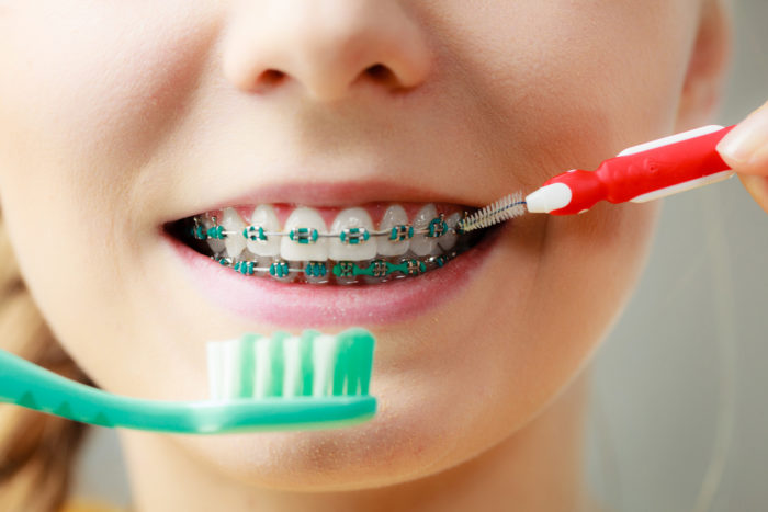 Nên chăm sóc răng miệng cho trẻ thế nào sau khi niềng răng - Lưu ý khi niềng răng cho trẻ 
