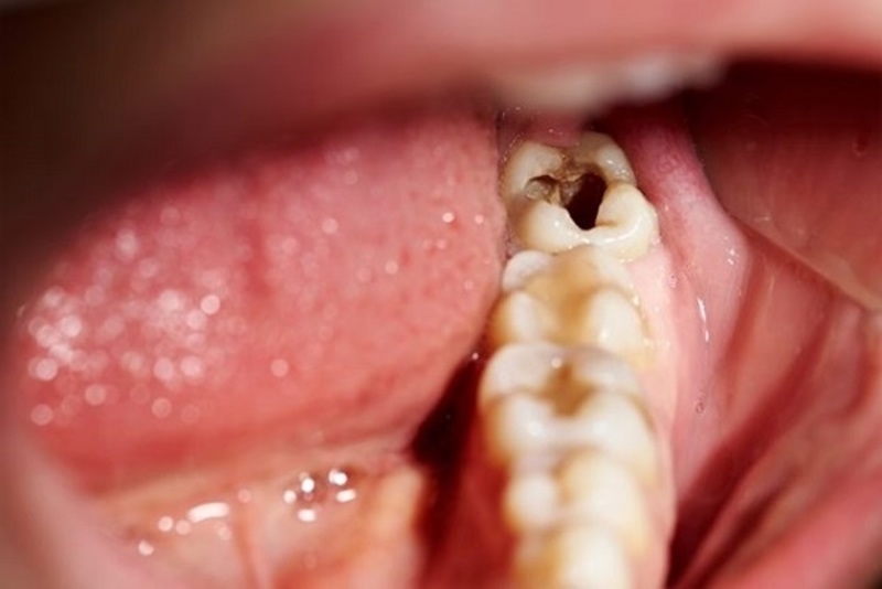 Nếu răng cấm của trẻ em bị hư hại thì phải làm sao?