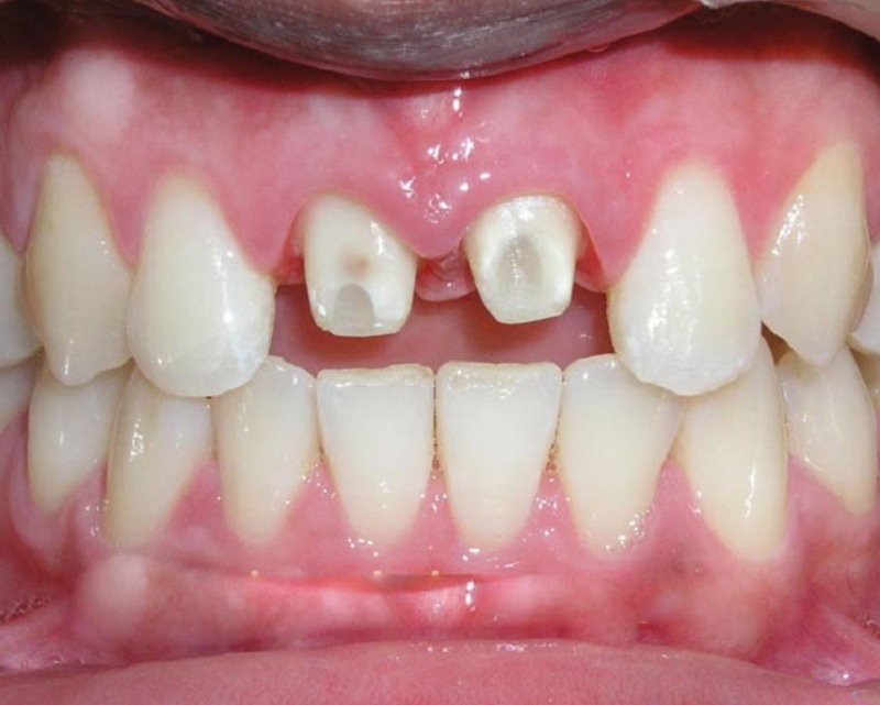 Nguyên nhân vì sao răng sứ bị rớt ra ngoài ?