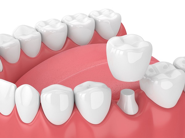 Những yếu tố ảnh hưởng tới giá của răng sứ Zirconia