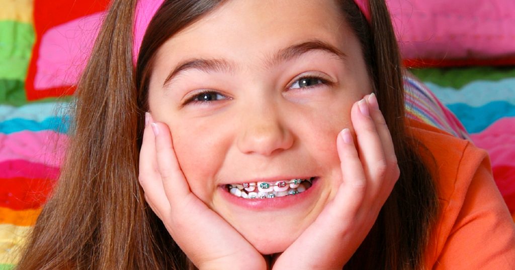 Niềng răng cho trẻ bằng phương pháp niềng răng mắc cài
