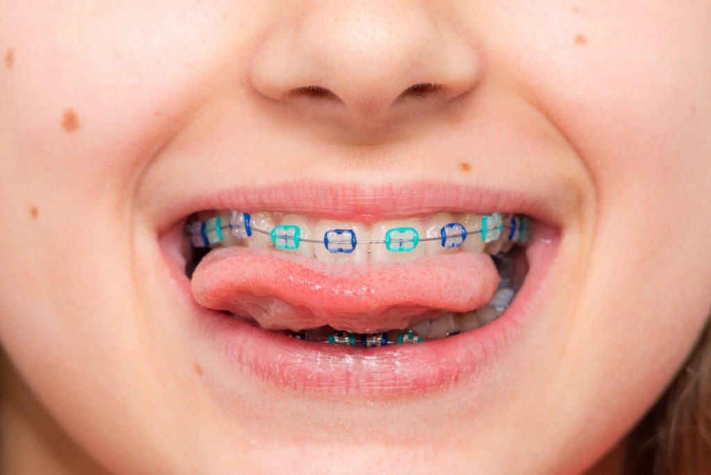 Niềng răng cho trẻ em có đau không?