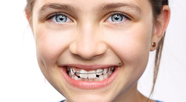 Niềng răng cho trẻ em là gì