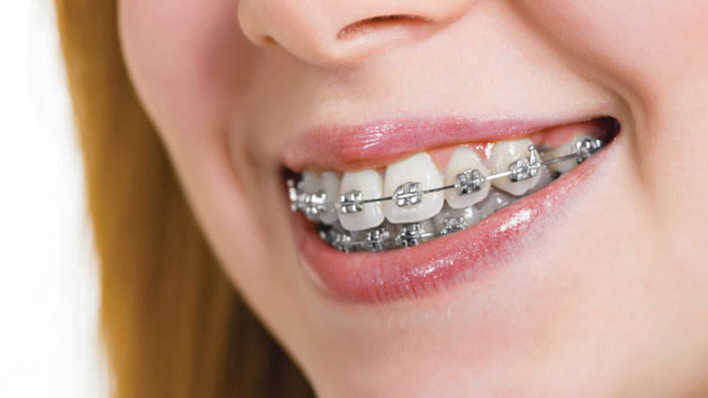 Niềng răng mắc cài kim loại phù hợp với một số trường hợp cụ thể