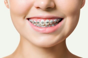 ưu điểm của niềng răng mắc cài kim loại