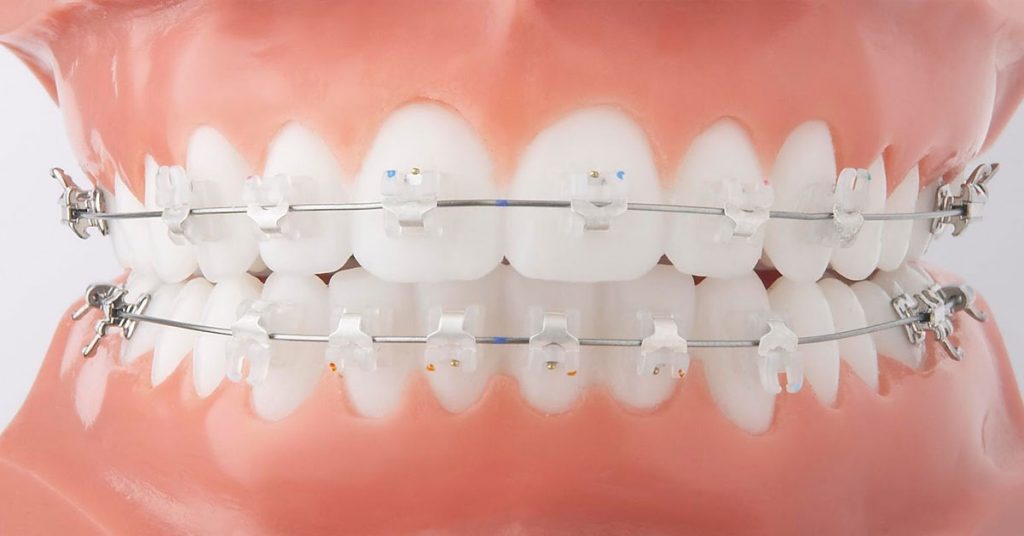 Niềng răng mắc cài sứ truyền thống là gì?