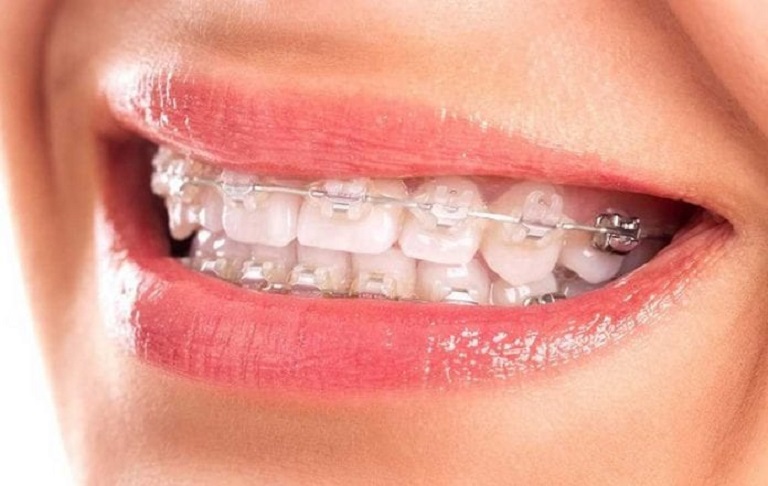 Niềng răng mắc cài sứ tự buộc là loại niềng răng gì?