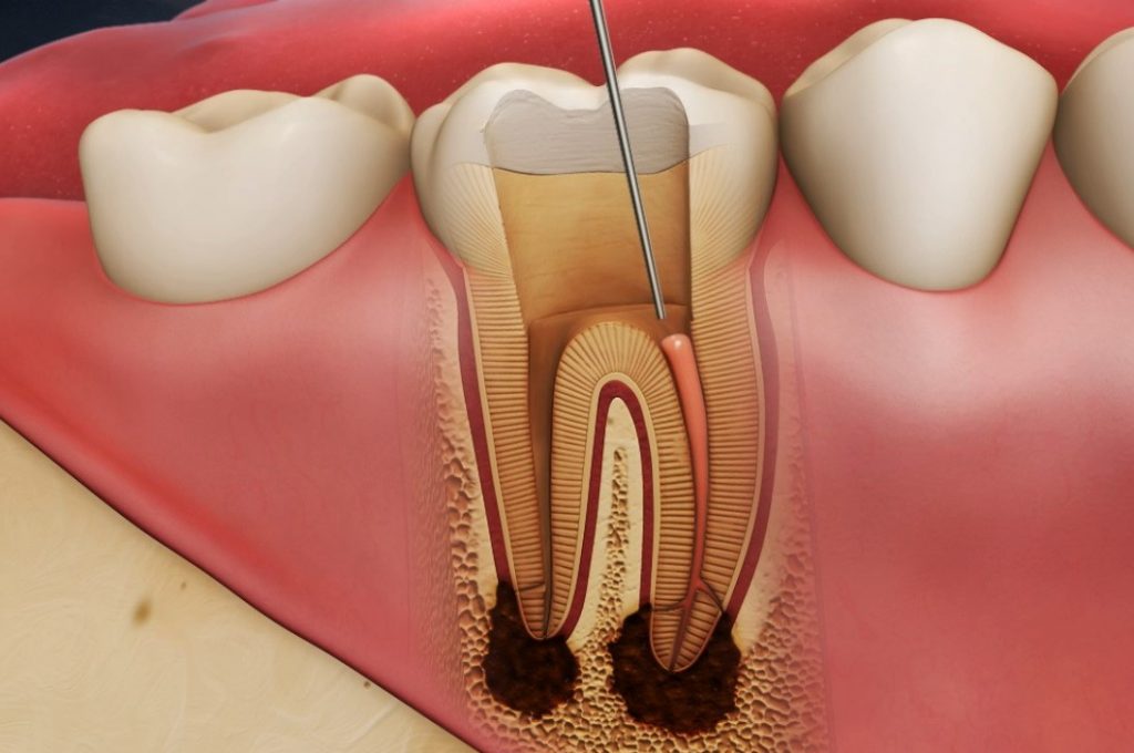 Niềng răng sai cách có khả năng dẫn đến nguy cơ chết tủy