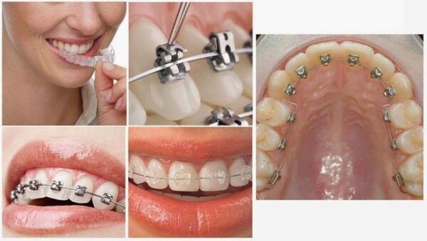 Niềng răng sớm hạn chế nguy cơ mắc bệnh