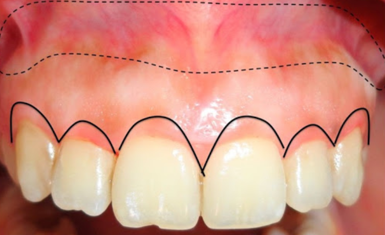 Phẫu thuật vạt kết hợp tạo hình xương ổ răng