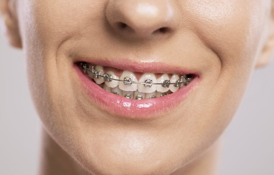 Phương pháp niềng răng bằng mắc cài kim loại là gì 