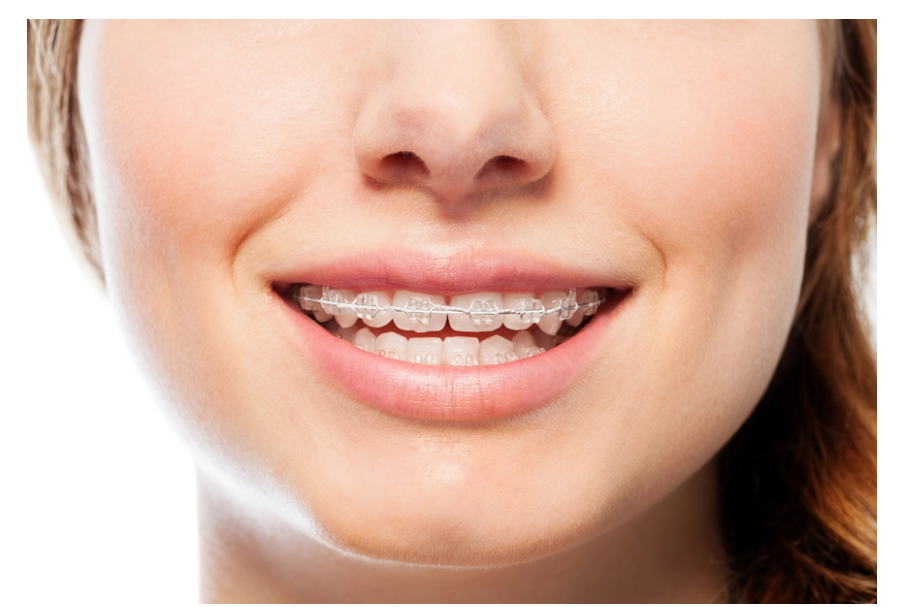 Phương pháp niềng răng mắc cài sứ là gì?