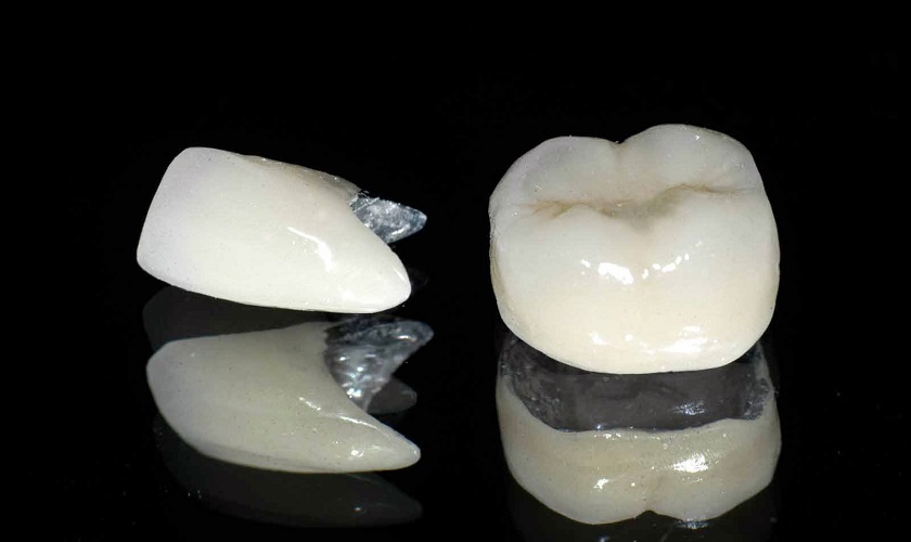 Răng sứ kim loại là gì? 